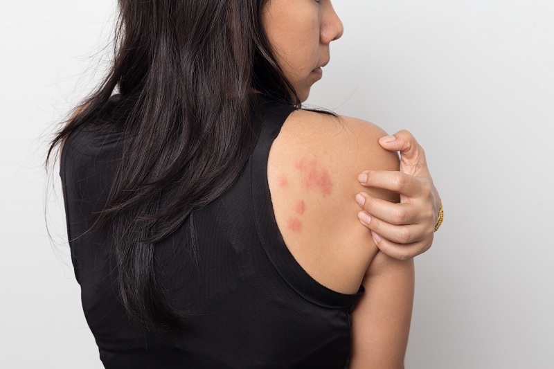 woman wearing black shoulderless top touching back of her shoulder that has skin rash